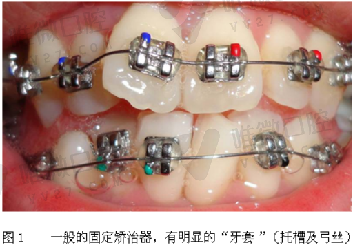 埋入式种植牙的优缺点（埋入式种植牙需要二次打开吗）(图1)